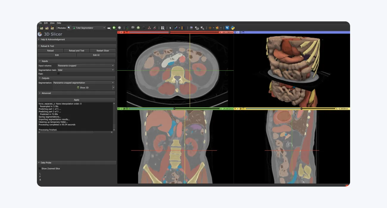 3D Slicer: Open-Source DICOM Viewer