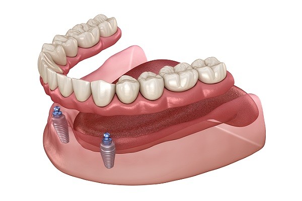 implant supported denture