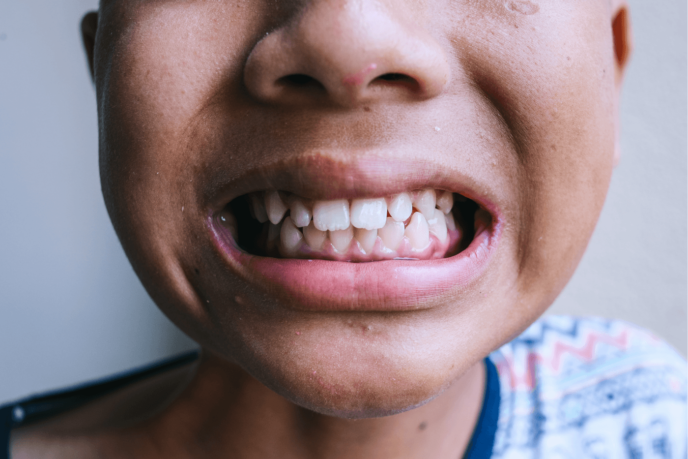 A close-up of a person's teeth showing minor misalignment issues.