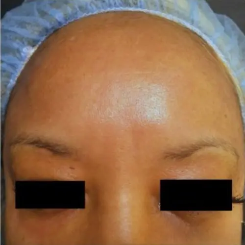 After pigmentation and discolouration treatment at The Vancouver Aesthetician — pigmentation visibly reduced and skin tone noticeably brighter and more even