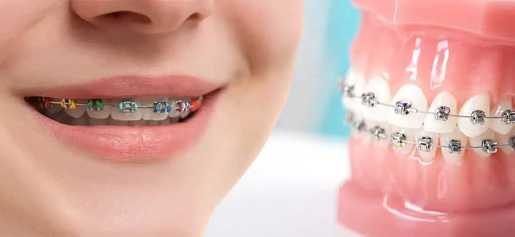 Fixed orthodontic braces treatment at COSDENT Smile Design