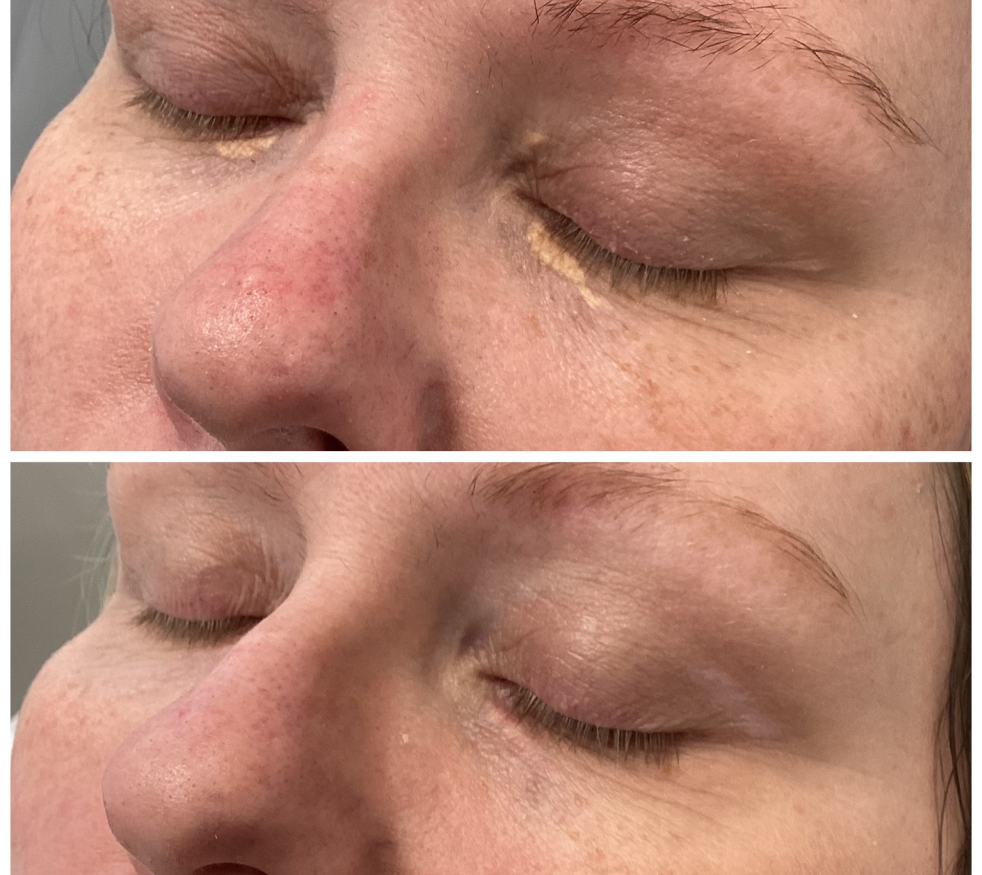 Laser treatment on woman's cheek with protective eye shield