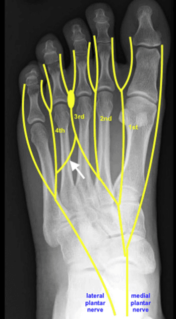 X-ray of Neuroma Treatment