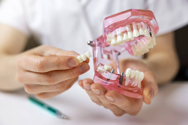 dental implants guide san jose