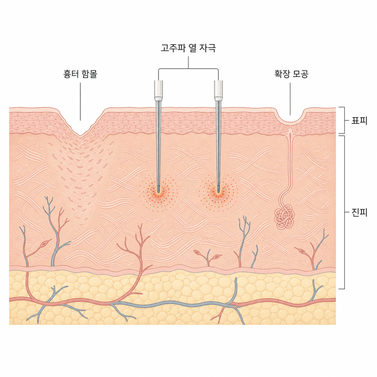 마이크로니들 RF의 진피층 작용 원리