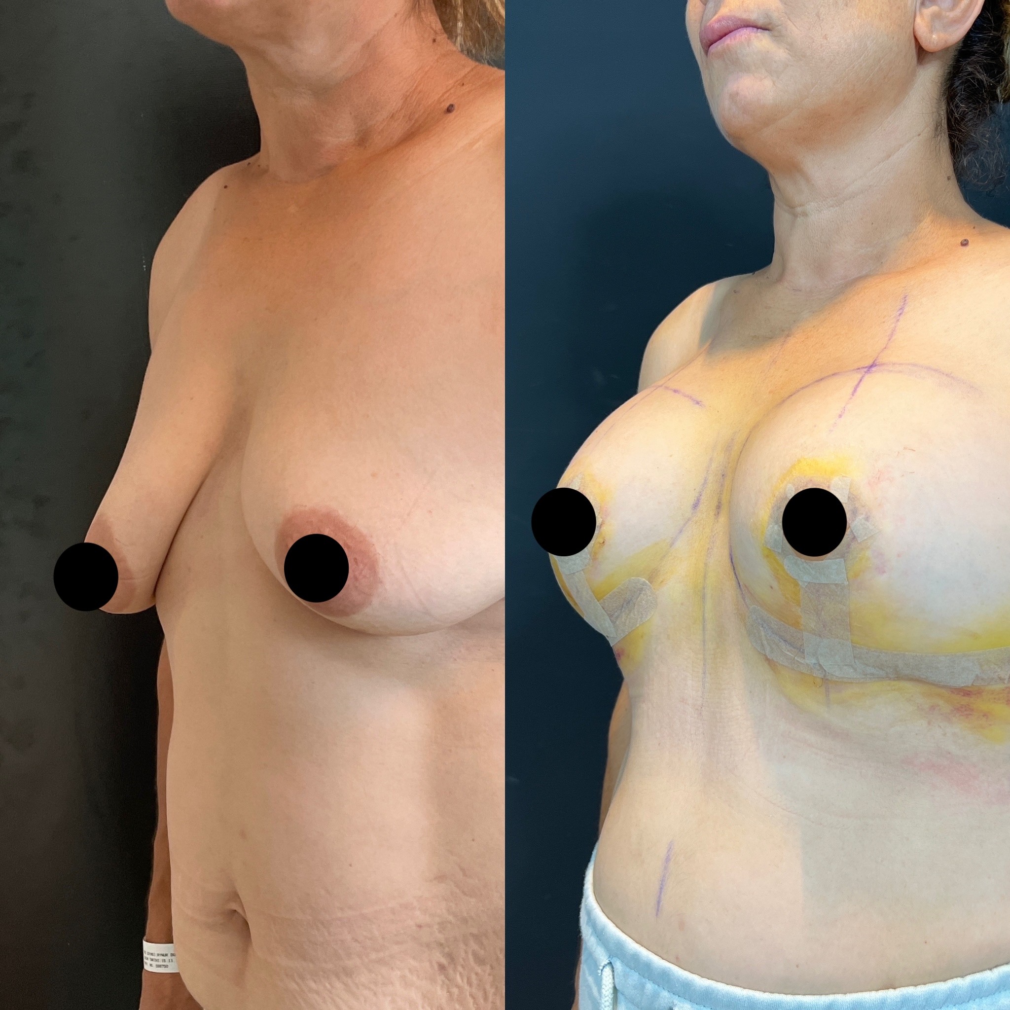 tuberous breast before after tubular breast left oblique view