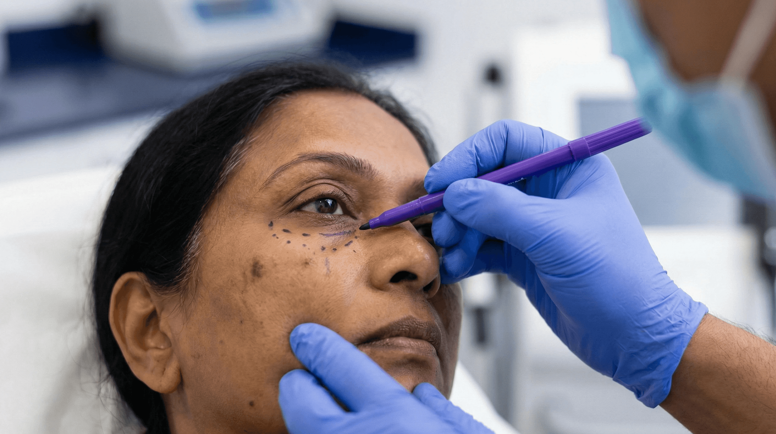 A close-up shot of a practitioner using a specialized marking pen to map out the tear trough anatomy on an Indian patient, ensuring a customized approach to volume restoration.