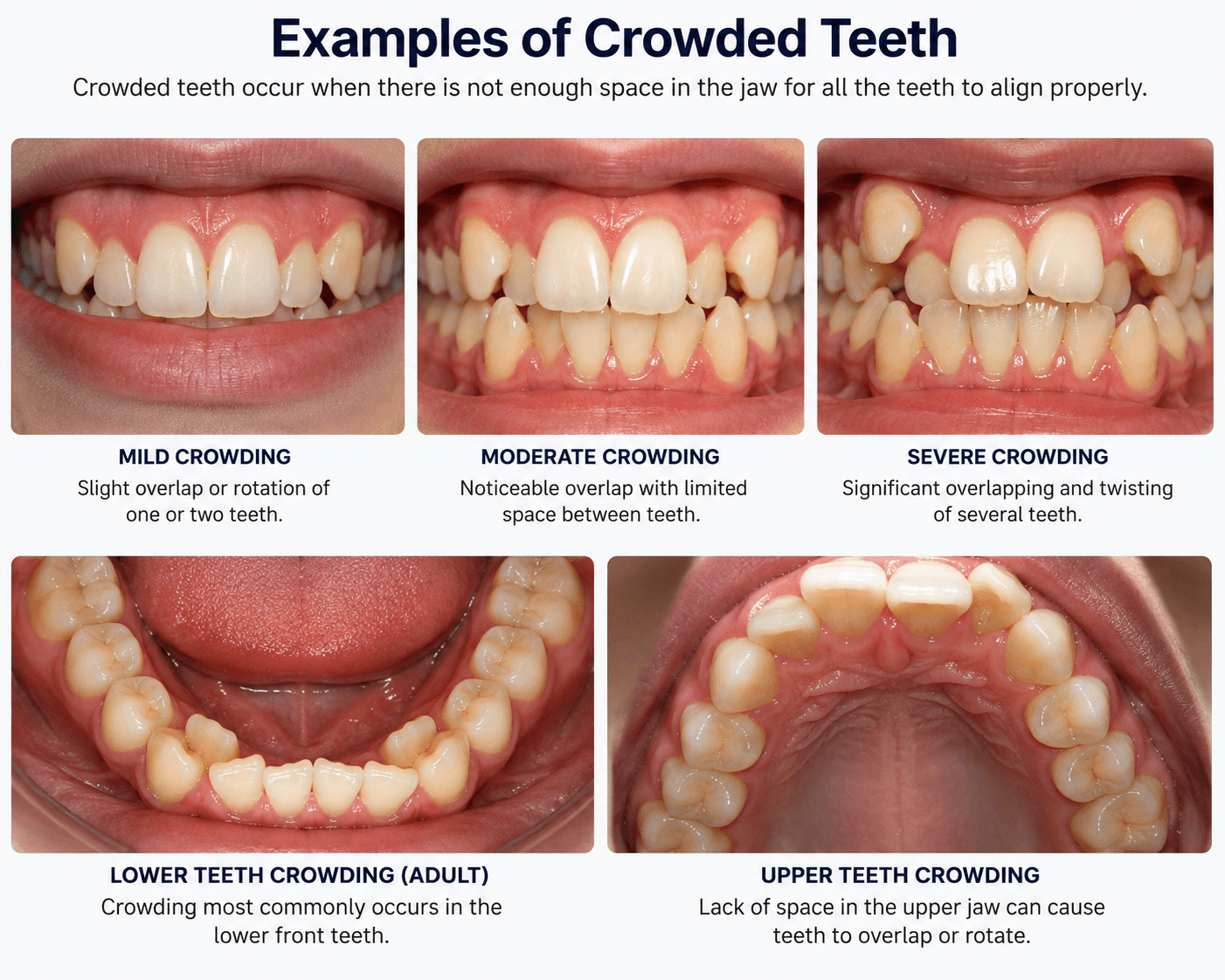 Types of crowded teeth