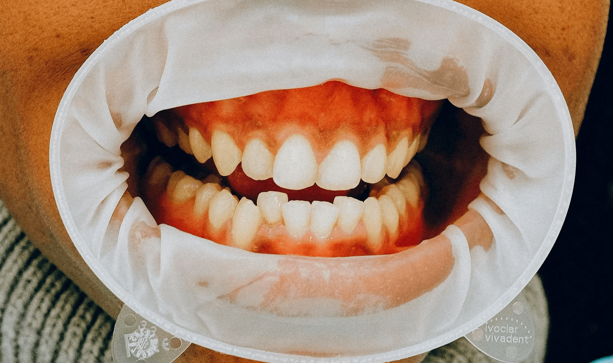 Cosmetic dental treatment