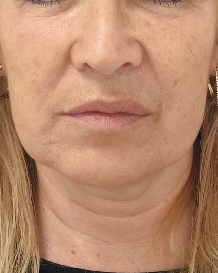 Poklesnuté kontúry sánky a unavený spodný profil tváre pred liftingom