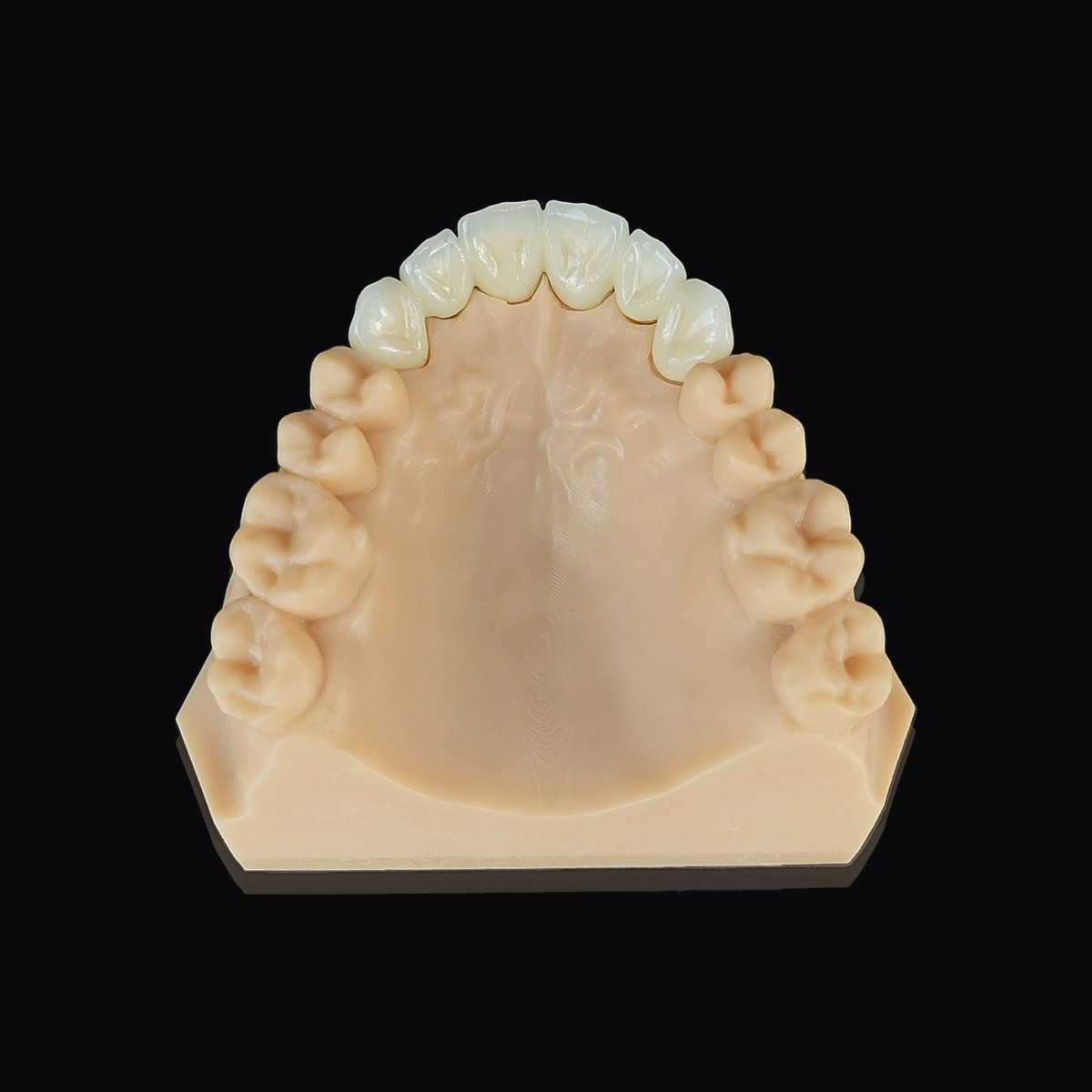 Couronne zircone stratifiée