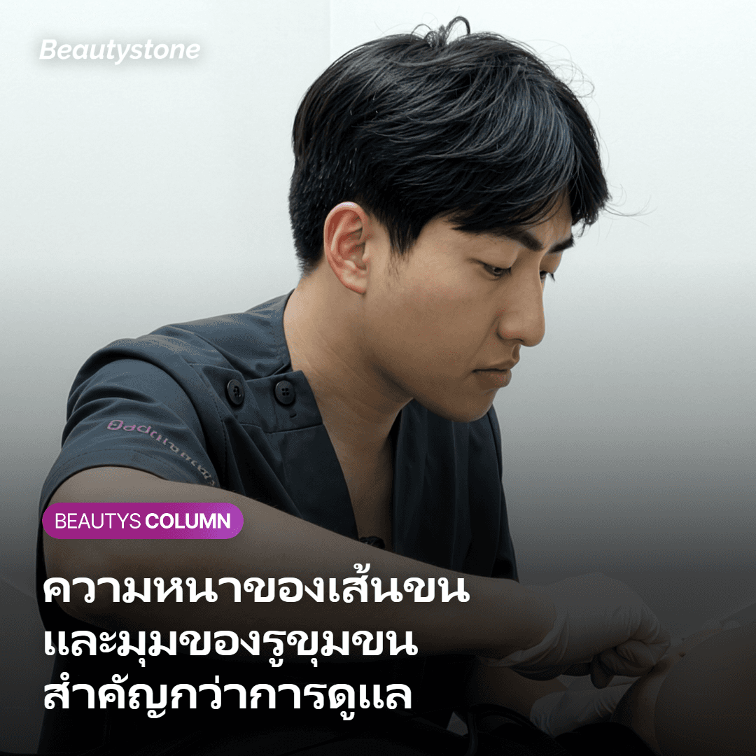 ภาพตัดขวางแสดงเส้นขนหนาที่ย้อนกลับเข้าผิวเมื่อรูขุมขนวางตัวเอียงราบ