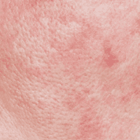 모공이 넓어진 형태 넓은 흉터 치료는 쥬베룩과 큐어젯 |  홍대 뷰티스톤의원 흉터 전문