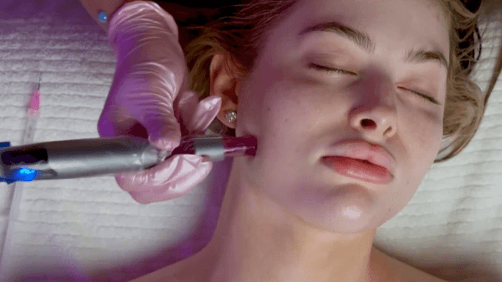 PRX WiQo® Microneedling to pair with ipl photofacial