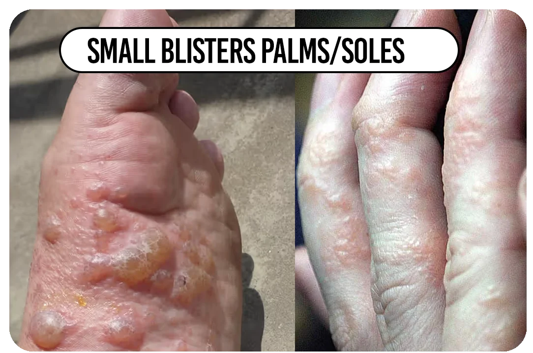 Small deep blisters palms/soles