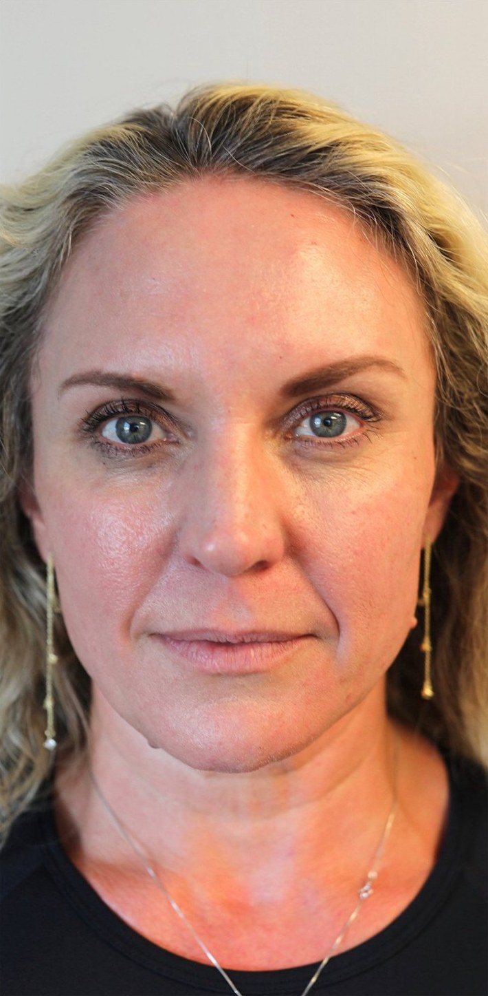 Before: a woman facing the camera.