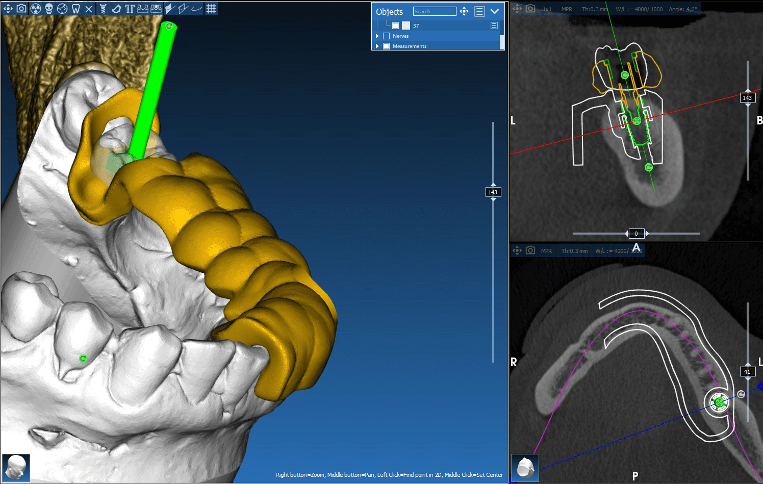 Planning implantaat en 