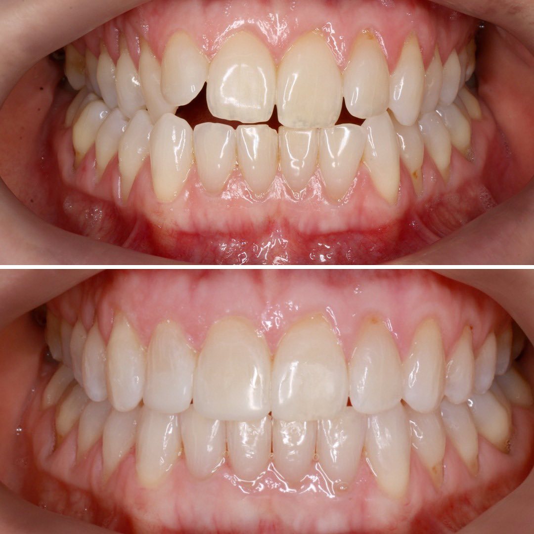 A transformation of invisalign before and after photo of teeth with open bite to aligned teeth at the Invisalign Center in Dubai.