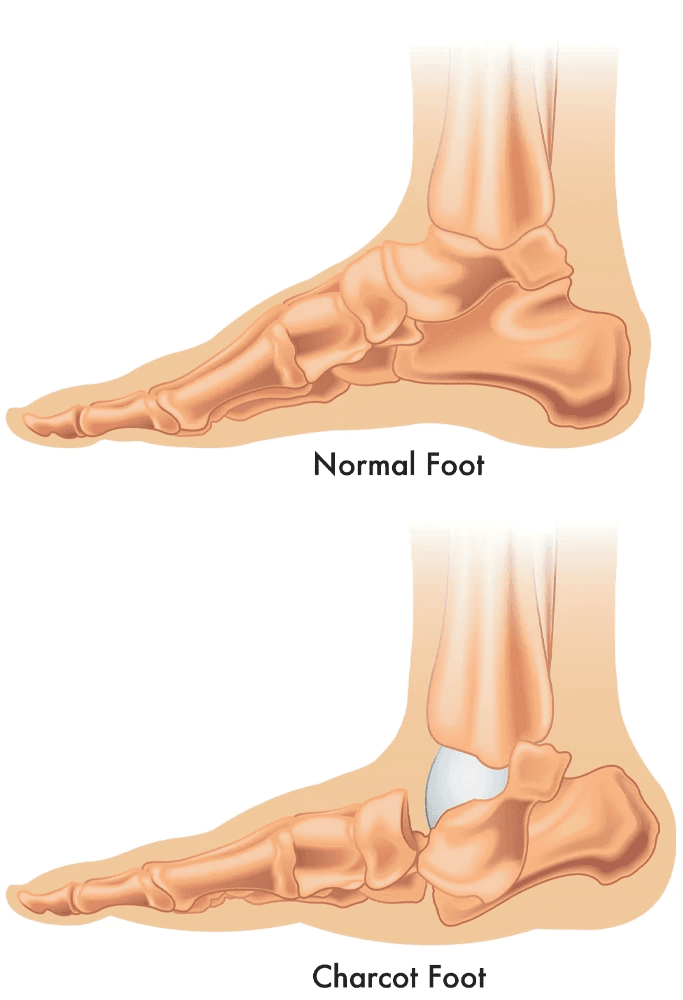 illustration of charcot foot reconstruction