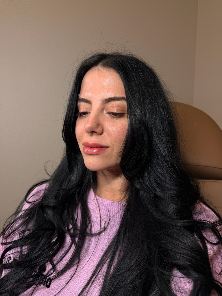 client showing lip filler results after treatment at The Dose Collective