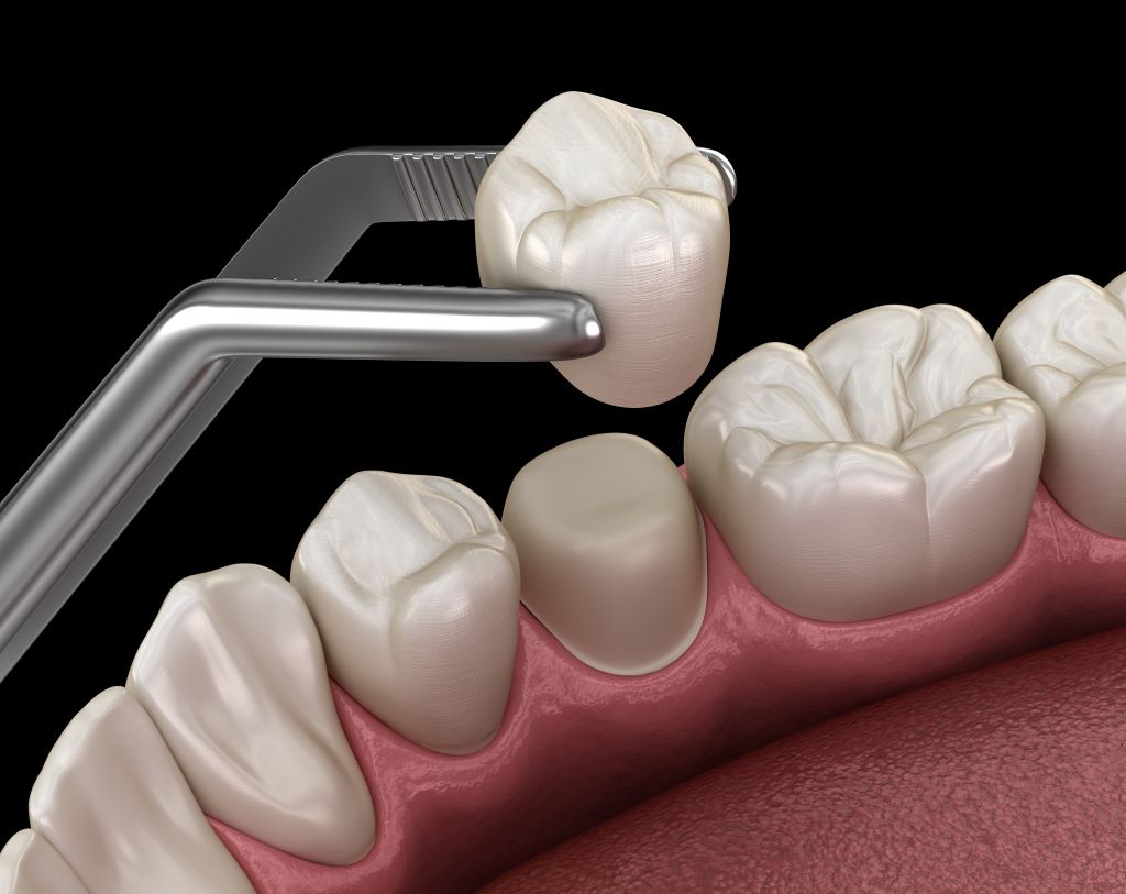 Same-Day Dental Crown Paramus