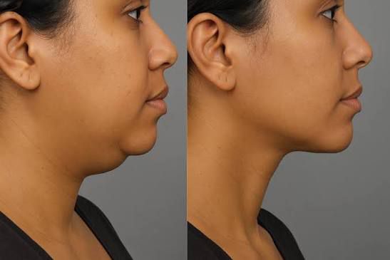 Woman before and after dental cosmetic improvements