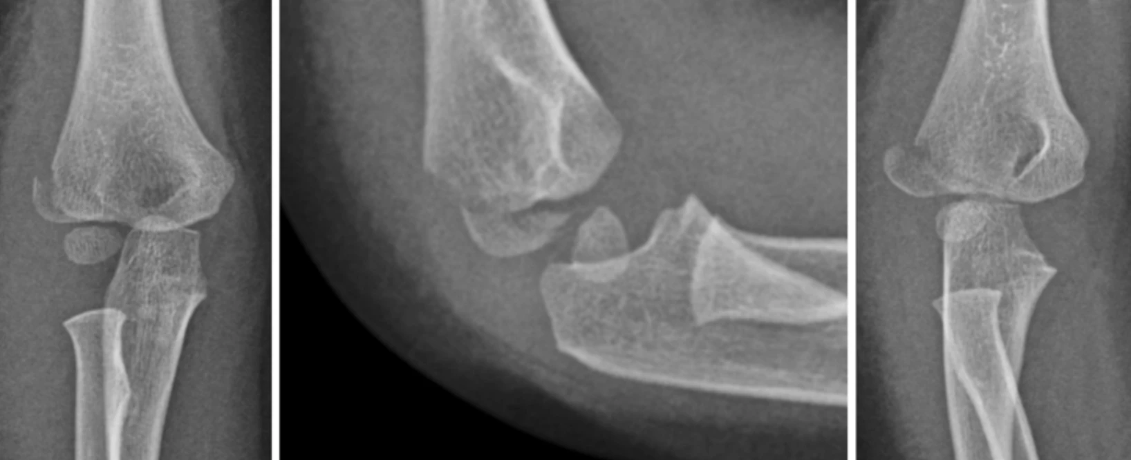 X-rays of a child’s elbow fracture from three views.