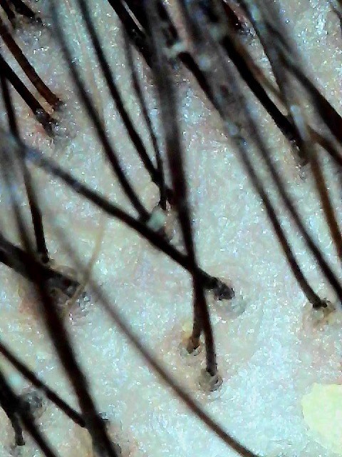 Microscopic close-up of an oily, congested scalp with mild irritation before treatment
