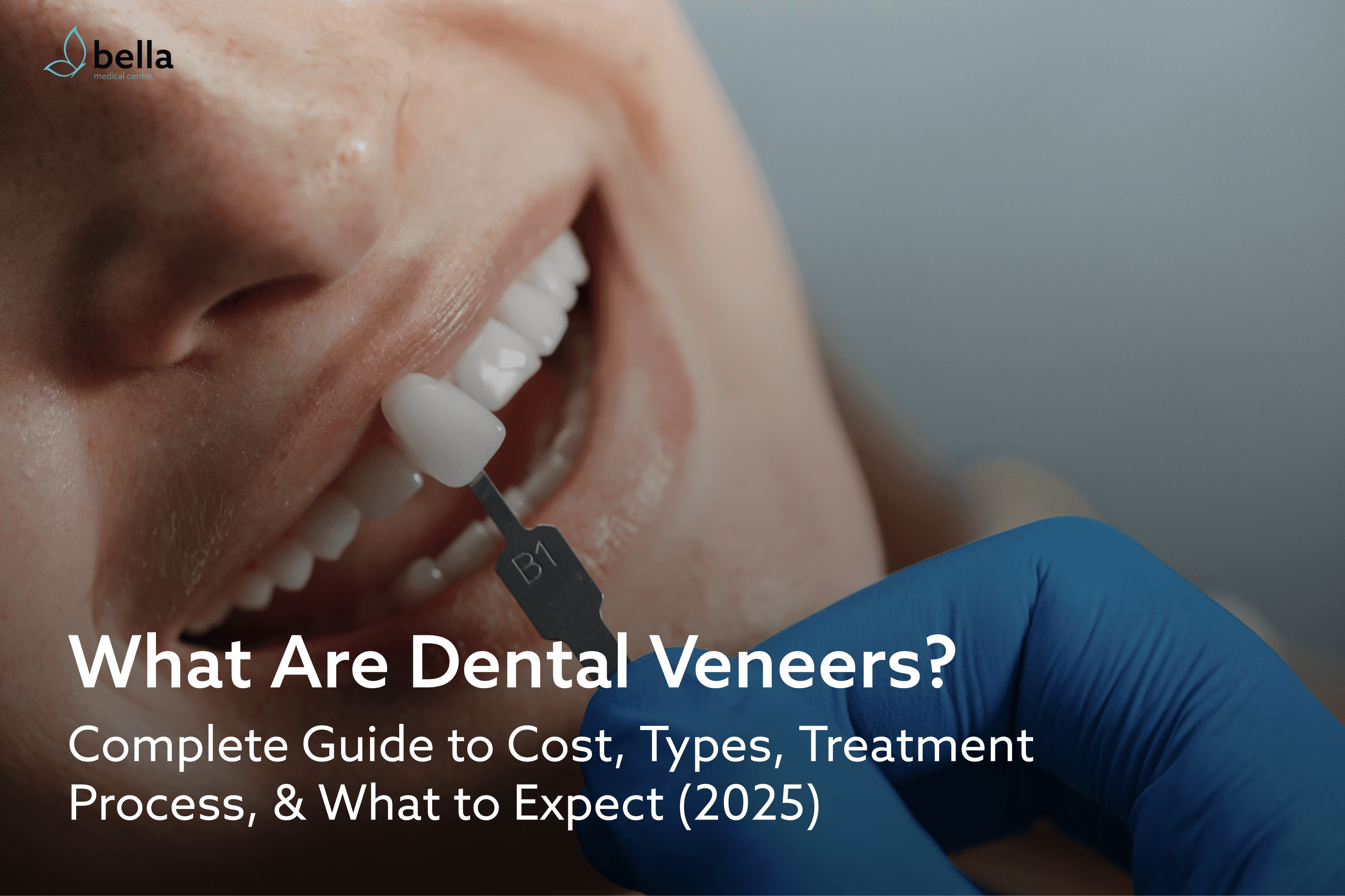 A detailed blog on dental veneers, how to get them, what to expect, cost and more. 