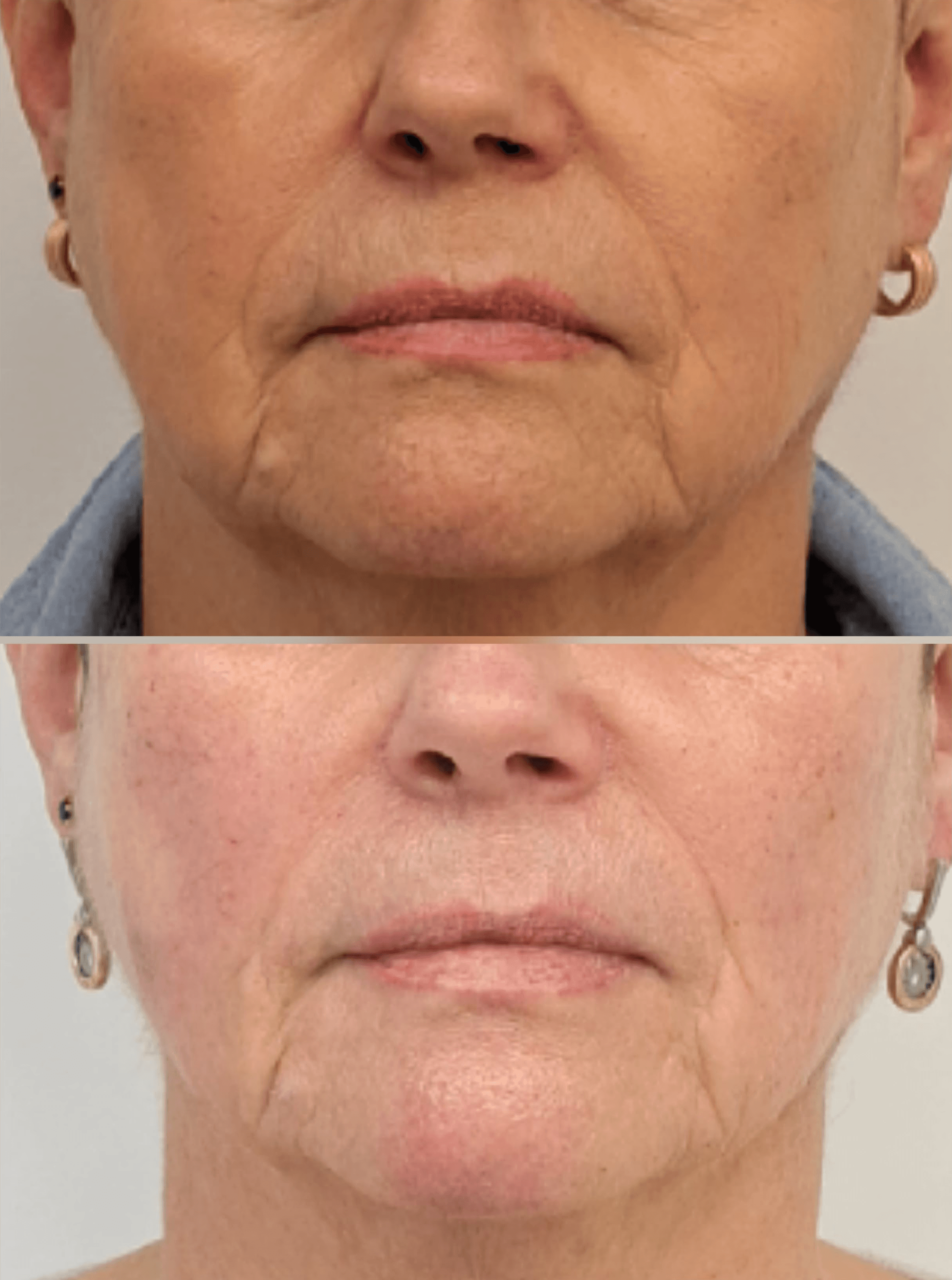 Neurolifting leszczenko_estGen_naturalny_lifting_bez_skalpela_szczecin_wrocÅaw