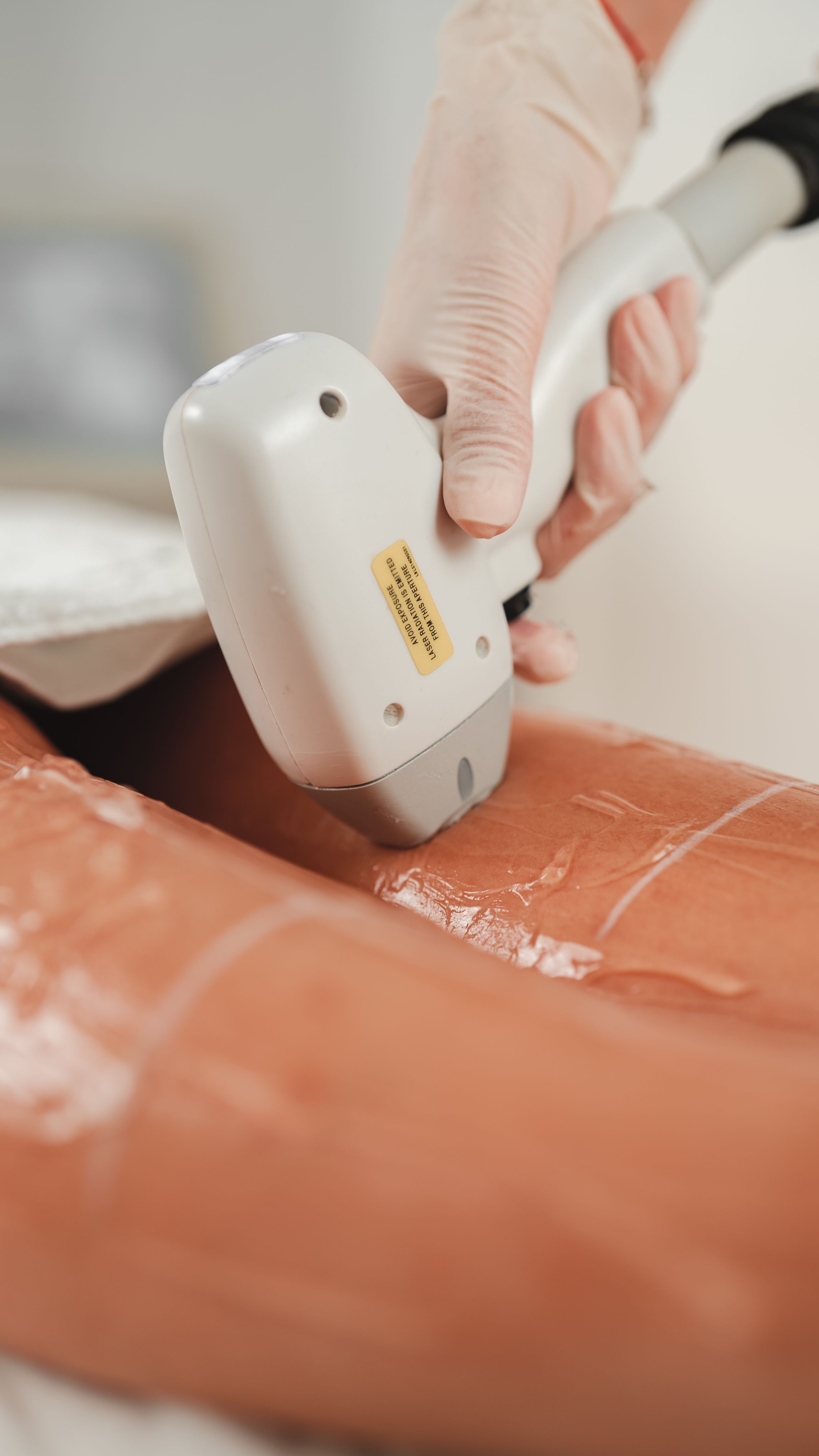 A laser treatment device used during a consultation-led session