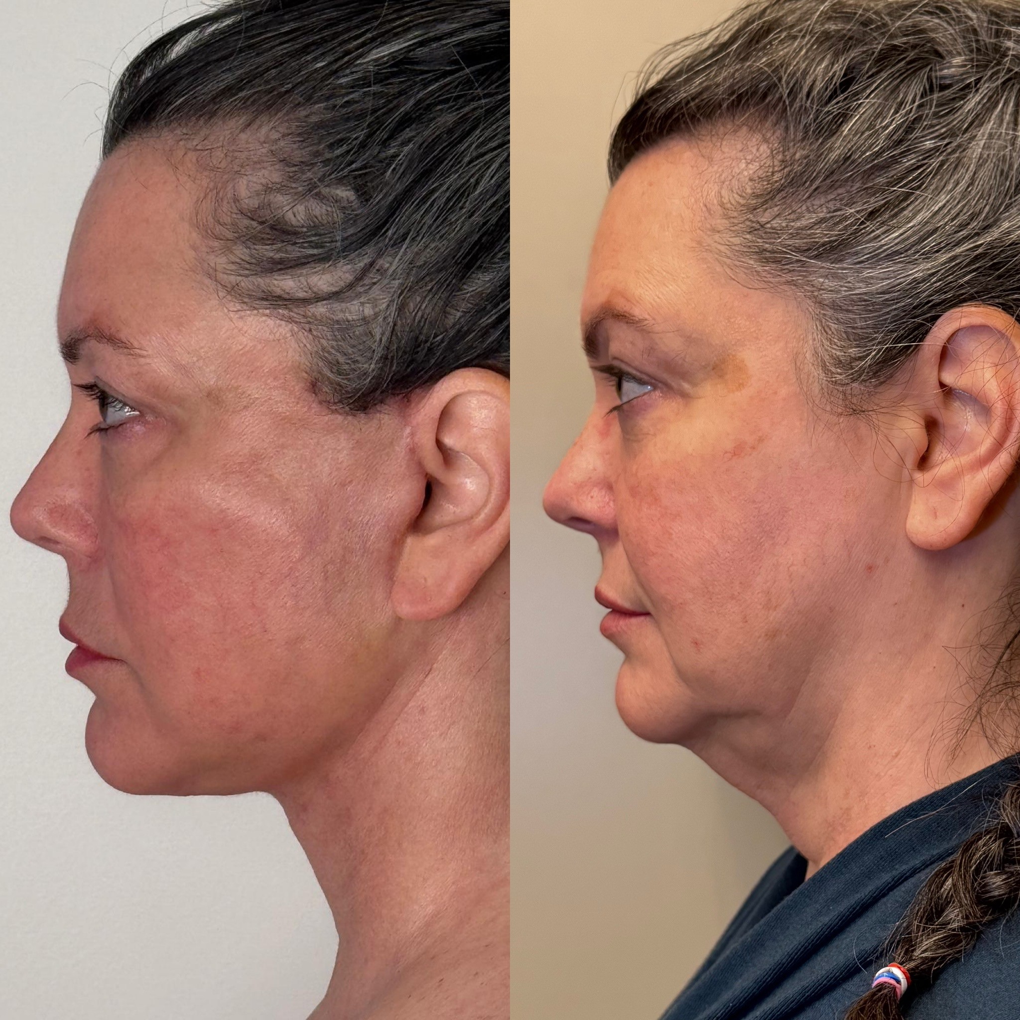 3 weeks result deep plane neck lift before after side view