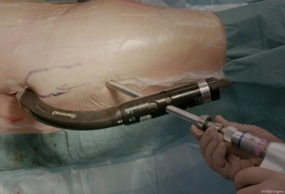 Gamma Nail for Intertrochanteric Femoral Fracture