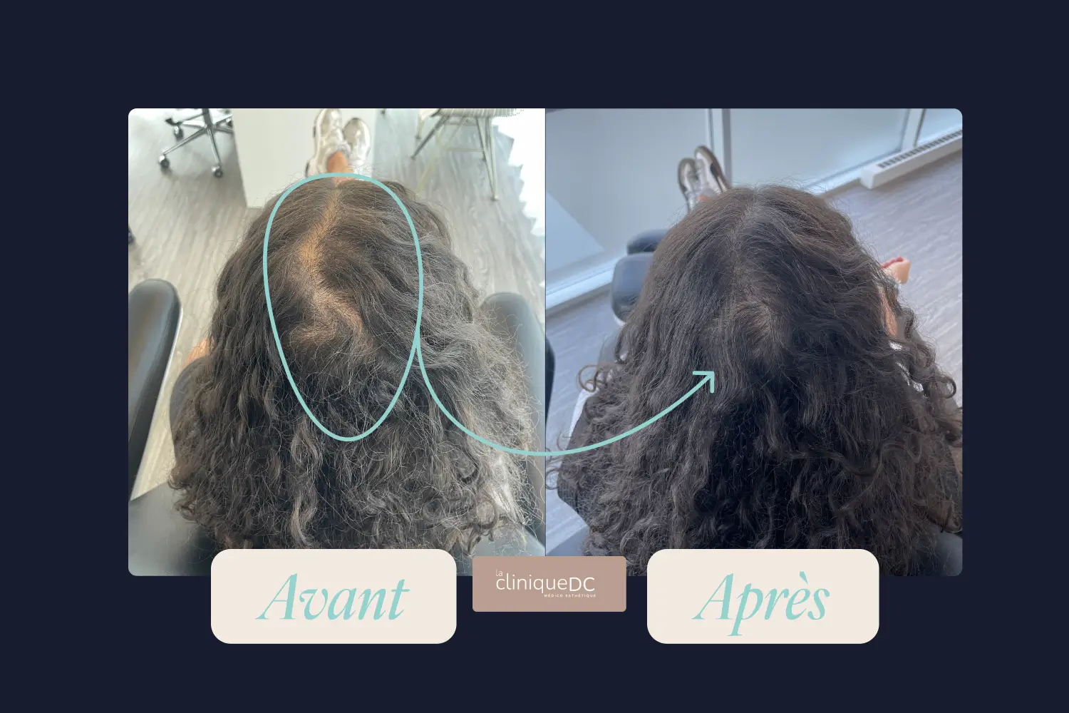 avant-après epilation laser visage