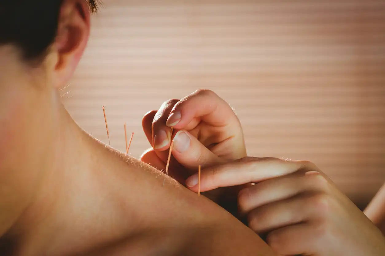 Therapeutic needling session with a practitioner inserting acupuncture needles into the upper back and shoulder area to relieve muscle tension.