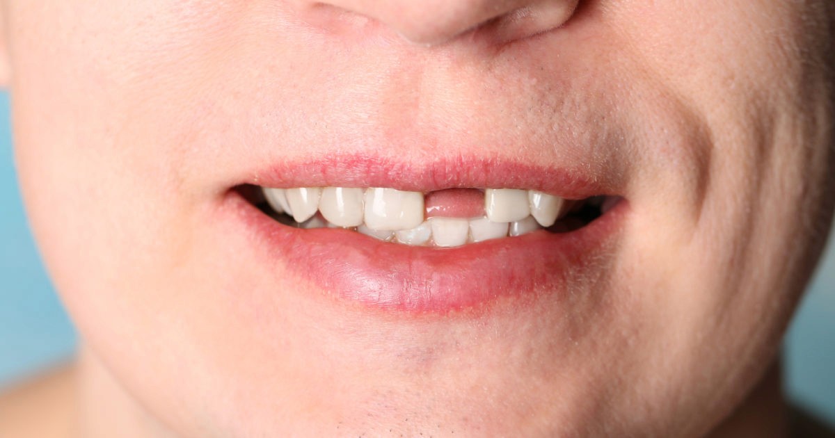 missing teeth solutions