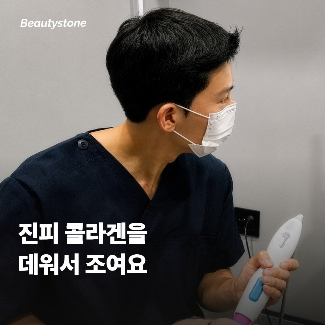알티테 RF가 중안면 탄력을 잡아주는 원리