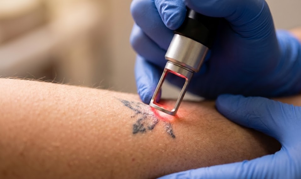 Tattoo verwijderen met de ND YAG laser bij Skin Boost Clinic Rijswijk