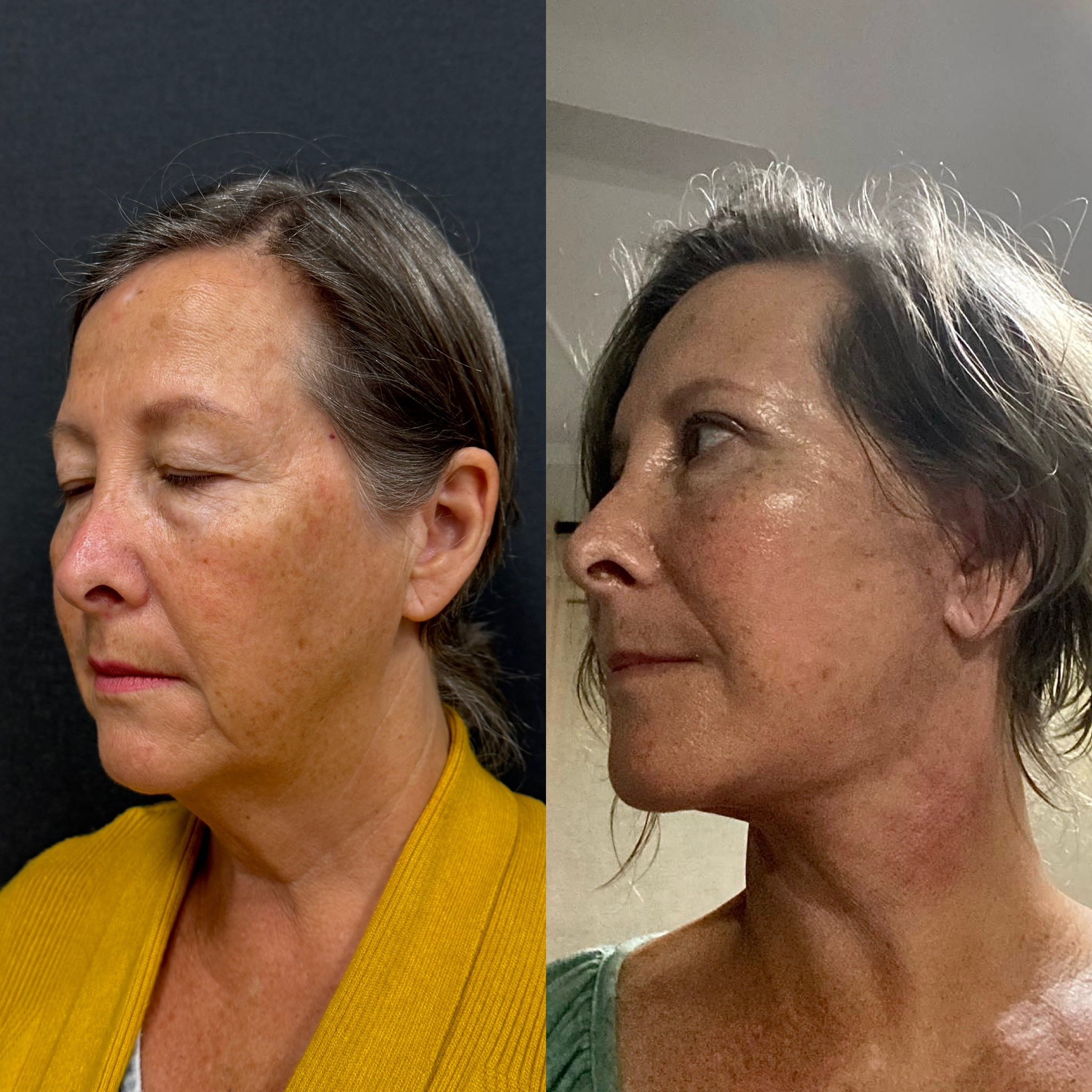 1 month before after deep plane face neck lift left oblique view