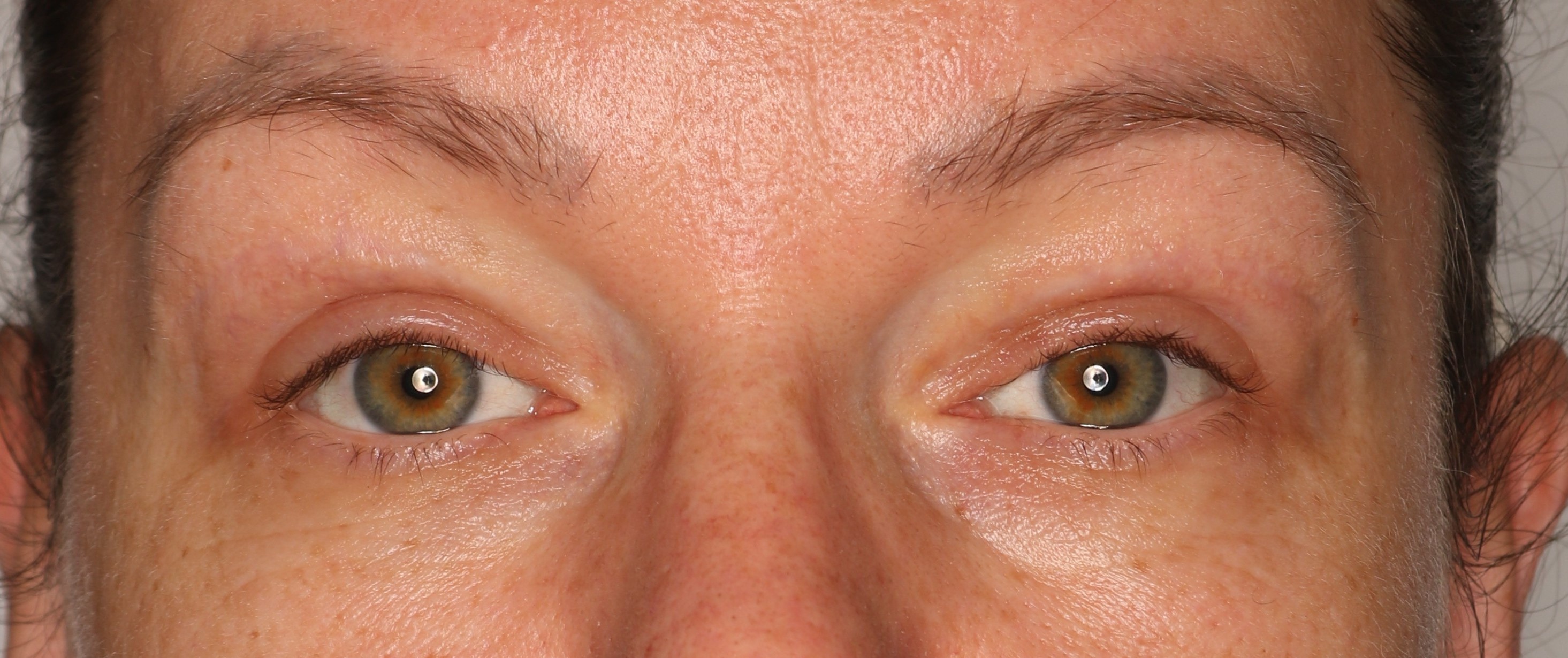 Efekt zabiegu plastyka powiek górnych - Po