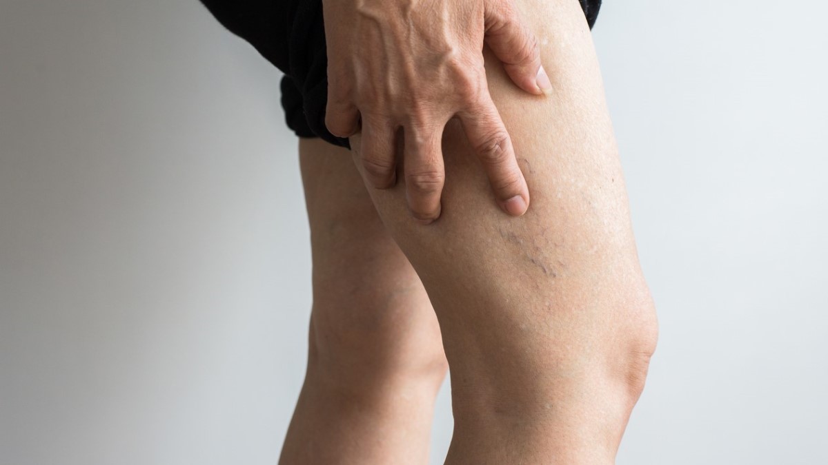 person with blood clot - Can Tirzepatide Cause Blood Clots