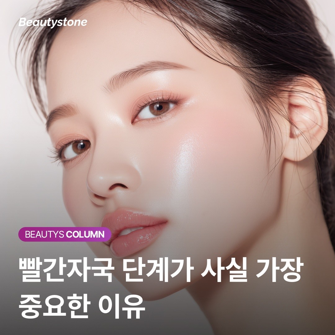 여드름 빨간자국 회복 단계 설명