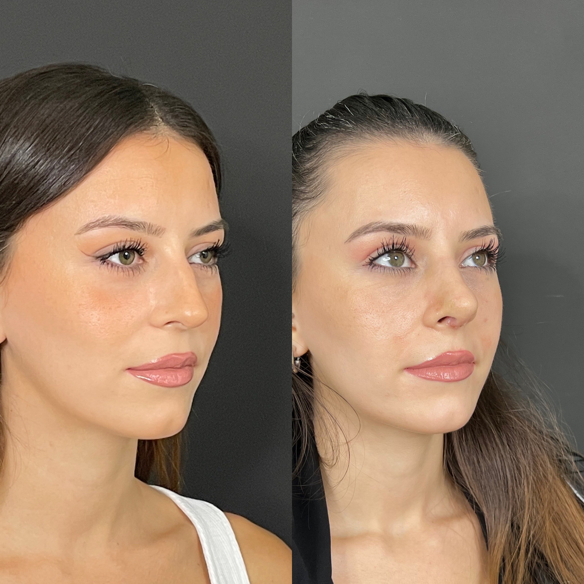 10 days rhinoplasty patient before after oblique view