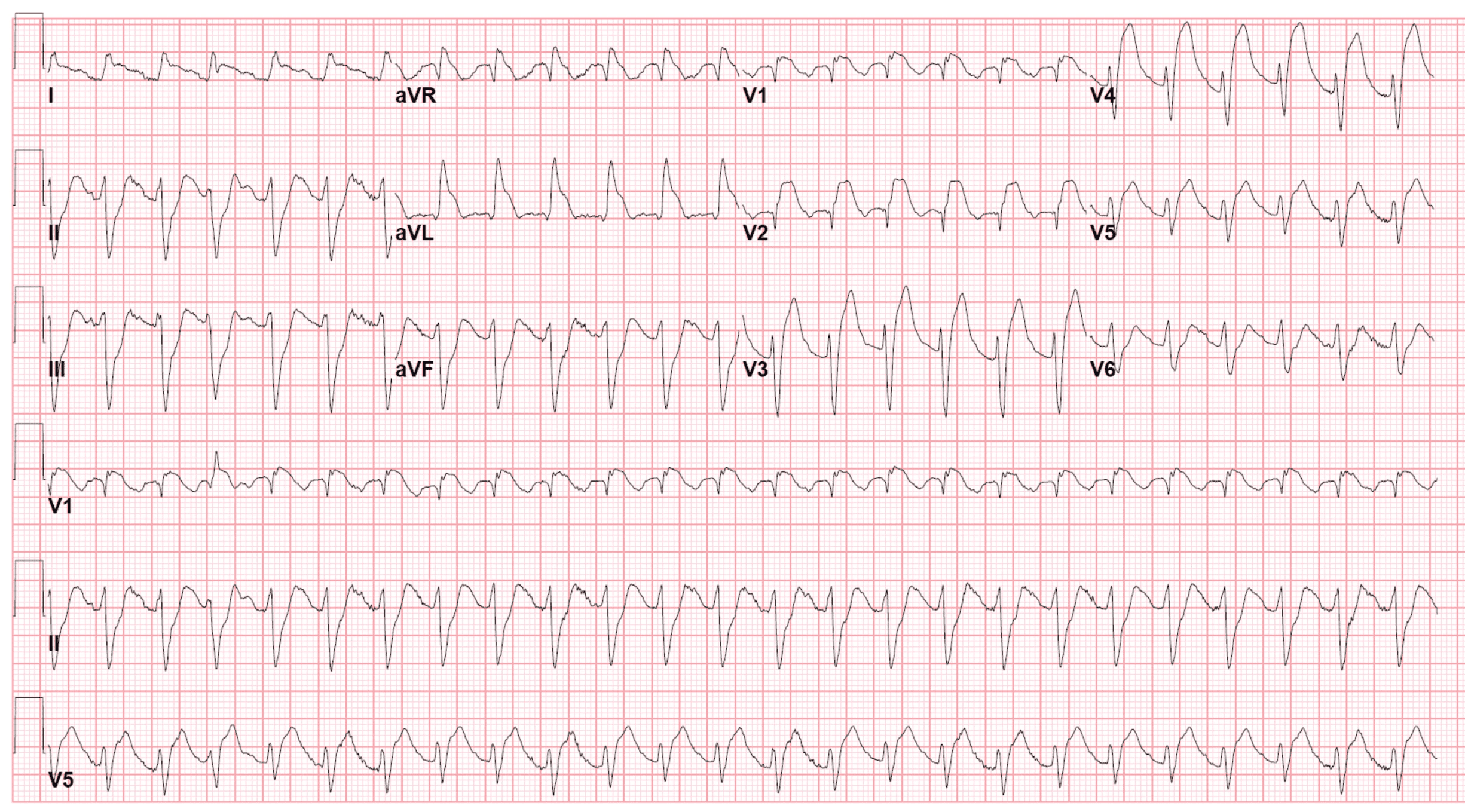 ECG on arrival