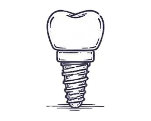 Hand-drawn illustration of a dental implant replacing a missing tooth