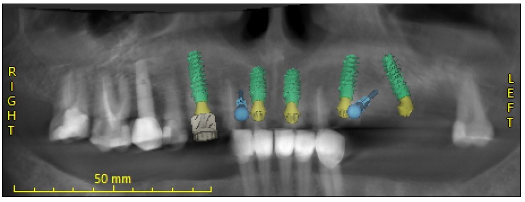 A dental panoramic X-ray image showing multiple dental implants with color-coded components for each implant, clearly labeled 'Right' and 'Left' with a 50 mm scale bar at the bottom at Oakville Dental Implant Studio