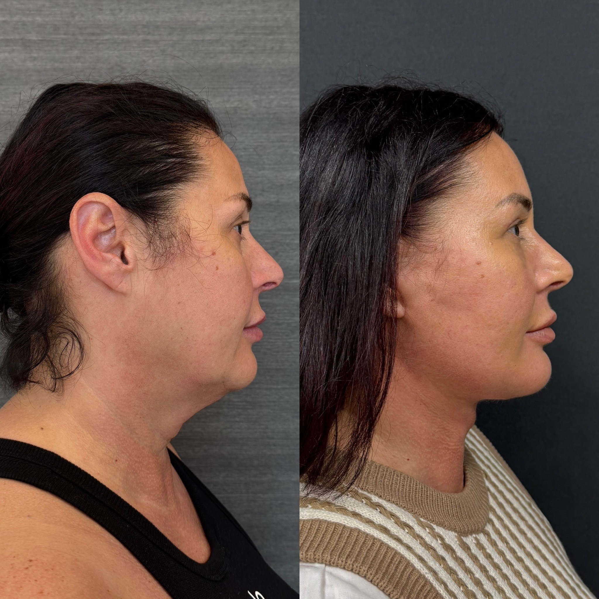 deep plane neck lift 1 month result before after photo right side view