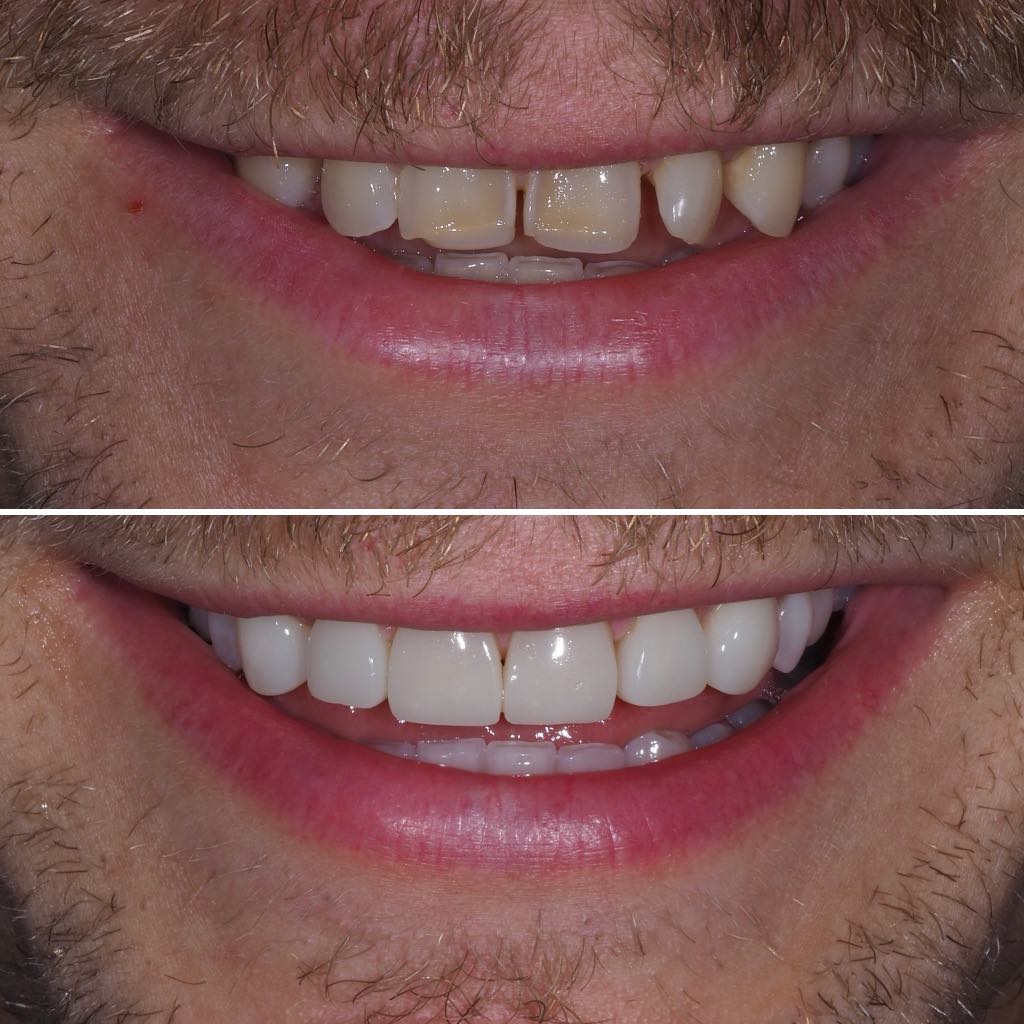 Before & After