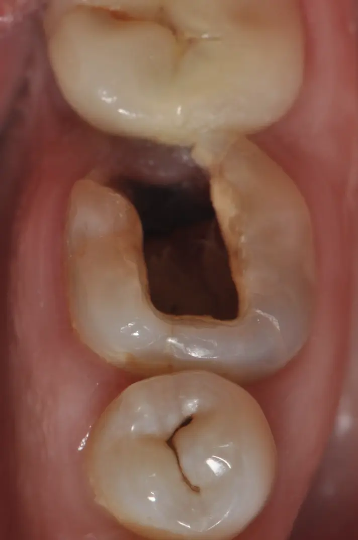 Remplacement d'une dent profondément fracturée, par un implant et une couronne en céramique