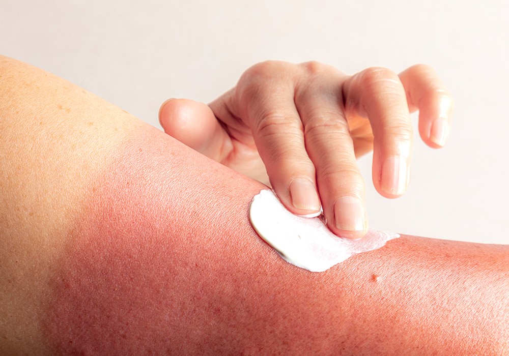 restoring skin after sunburn